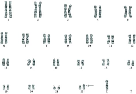 Karyotype of the case was found to include chromosome 45,X,der(Y;22 ...