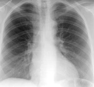 Subaortic Stenosis: Indications for Surgery | Thoracic Key