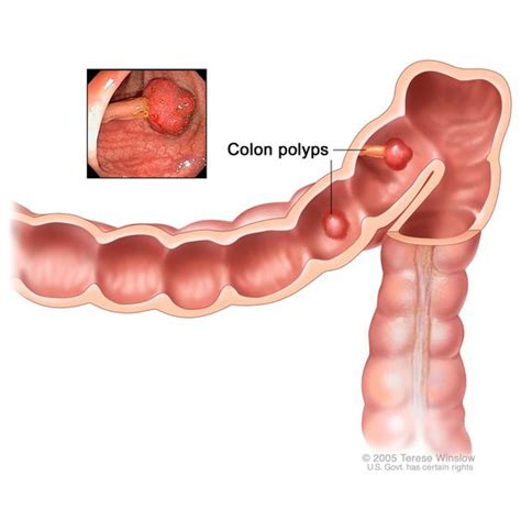 Colon Polyps - NIDDK