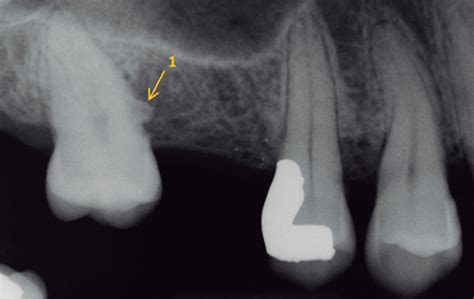 Treatment of an Unusual Non-Tooth-Related Enamel Pearl (EP) and 3 Teeth ...