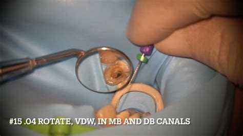 Single visit root canal treatment of 3 canals upper premolar and perforation repair - YouTube