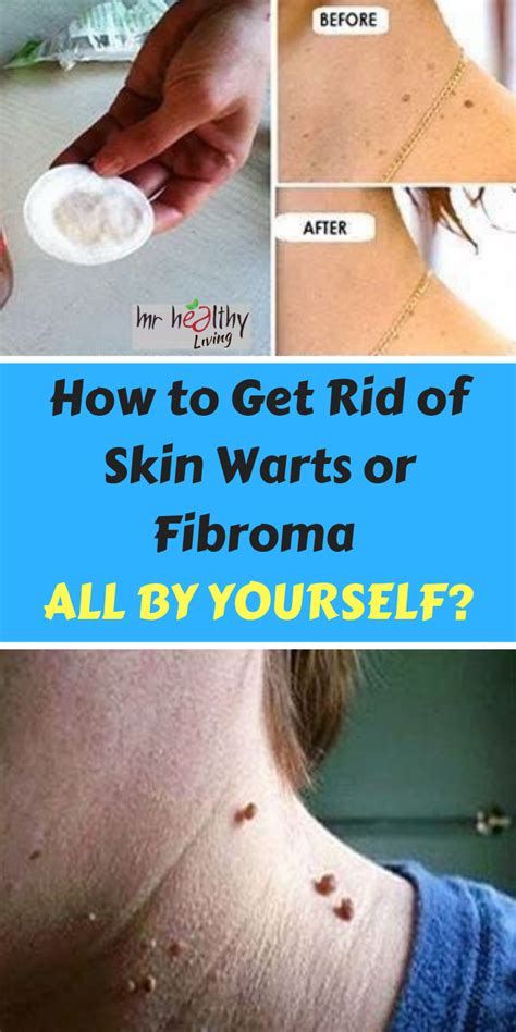 How To Remove Warts Around Neck - HOWTOREMVO