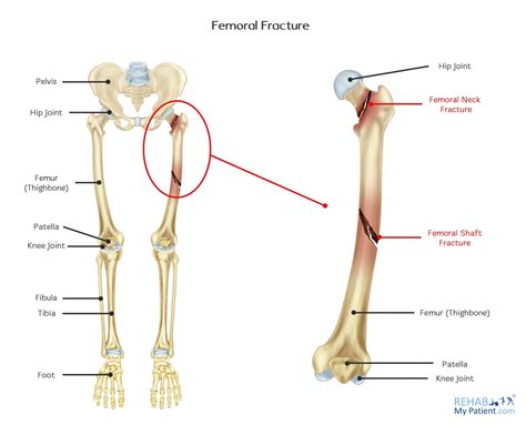 Femoral Fracture | Rehab My Patient