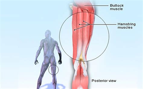 How to Heal a Pulled Hamstring? - Top Fitness Guides