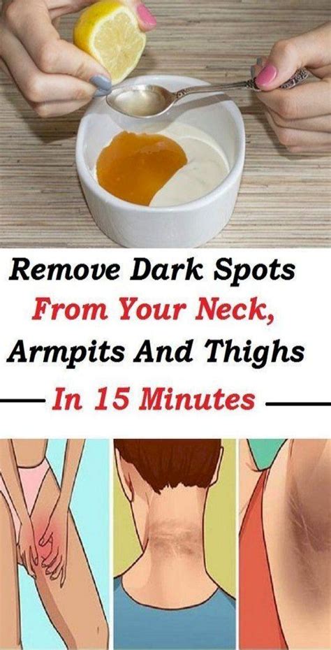 How To Get Rid Of Dark Neck In 20 Minutes - News | Dark spots on skin, Skin spots, Dark spots on ...