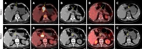 Portacaval Lymph Nodes