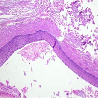 (PDF) A Recurrence of a Giant Odontogenic Keratocyst: Radiographic Follow-Up