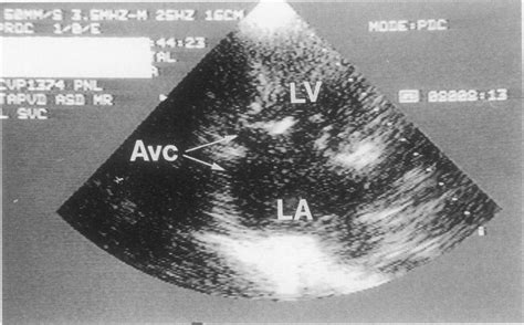 Patient 3: this transthoracic echocardiogram indicates partial ...