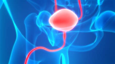 Bladder cancer - Understanding intravesical treatment for bladder cancer