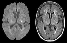 Lacunar Infarct: Causes, Symptoms, and Management