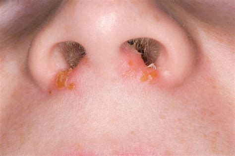 Impetigo Infection On Nose Photograph by Dr P. Marazzi/science Photo Library