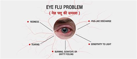 Understanding Eye Flu: Definition, Causes, Symptoms & Treatment