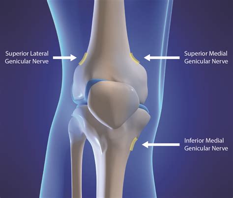Genicular Neurotomy | Nerve Ablation | Ainsworth Institute