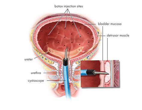 Overactive Bladder Montreal Treatment