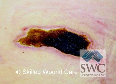 Eschar on an unstageable wound | Tissue types