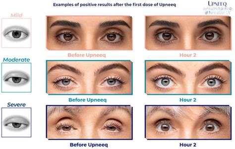 Droopy Eyelids Getting in the Way? | Vision Care Associates