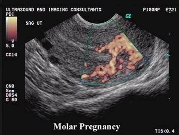 How Early Can A Molar Pregnancy Be Detected By Ultrasound - PregnancyWalls