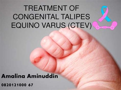 Mellss yr5 ortho treatment of congenital talipes equino varus (ctev)