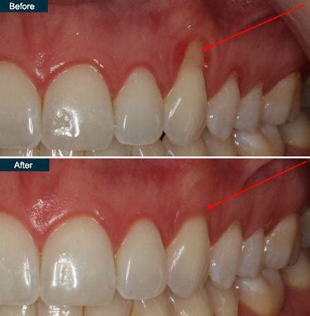 Receding Gums Treatment in NYC - New York Periodontist Dr. Rahmani