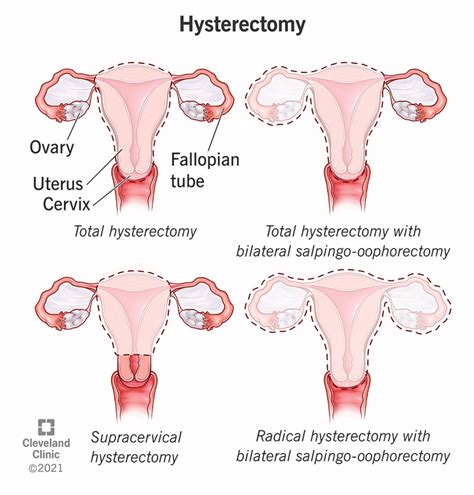 Hysterectomy: Purpose, Procedure, Benefits, Risks & Recovery