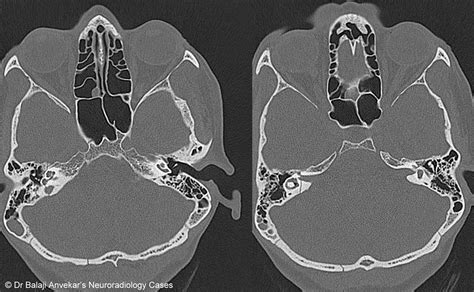 Dr Balaji Anvekar FRCR: Temporal Bone Fracture with Facial Nerve Palsy