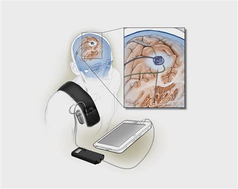 Adaptive deep brain stimulation for Parkinson’s disease | National ...