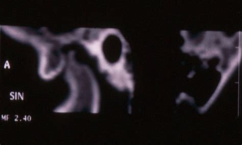 Temporomandibular Joint Arthroscopy versus Arthrotomy | IntechOpen