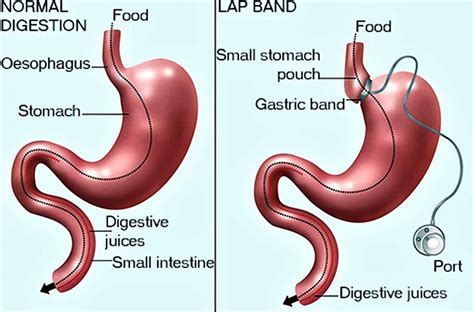 What is Lap Band Surgery & its Side Effects? | Better Weigh Center