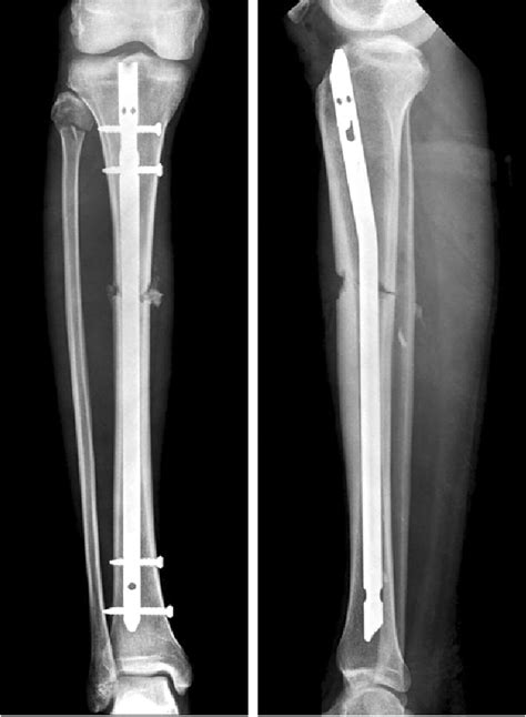 Tibial Nail Starting Point - Nail Ftempo