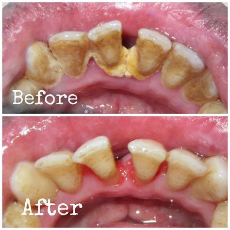 DENTAL TALKS: What is Scaling of teeth