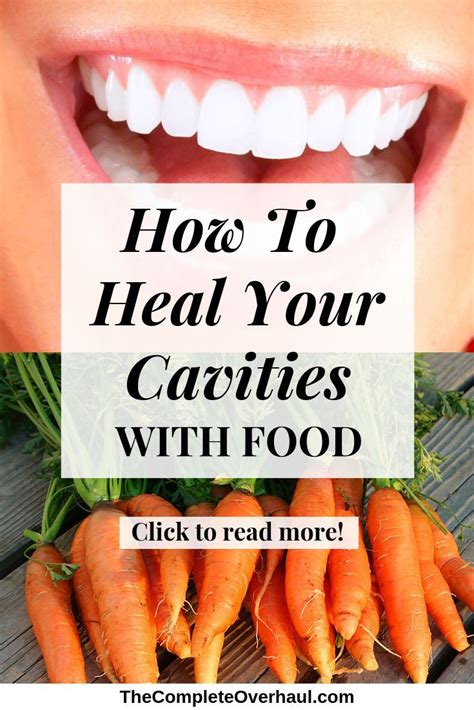 How To Heal Your Cavities And Shock Your Dentist | Cavities, Teeth health, Healthy teeth