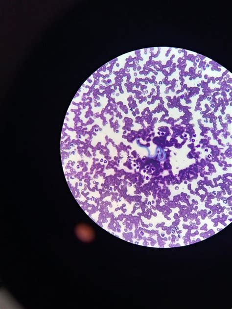 Heartworm found in canine patient's blood smear. : Hematology