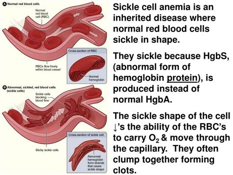 PPT - Sickle cell anemia is an inherited disease where normal red blood ...