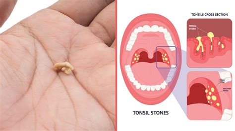 4 Things That Cause Tonsil Stones (And How to Prevent Them)