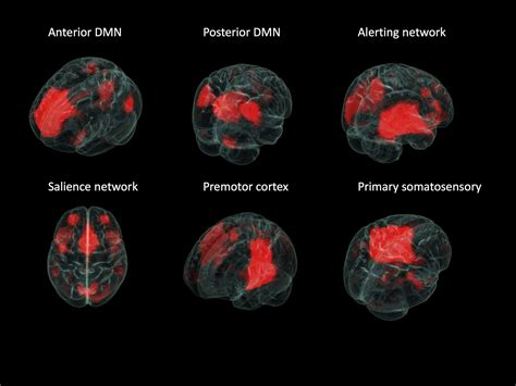 Epilepsy Brain