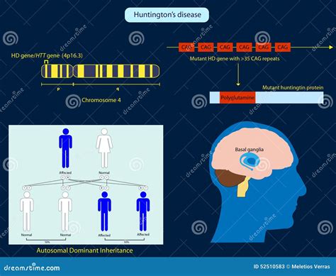Chorea Huntington stock abbildung. Illustration von gehirn - 52510583