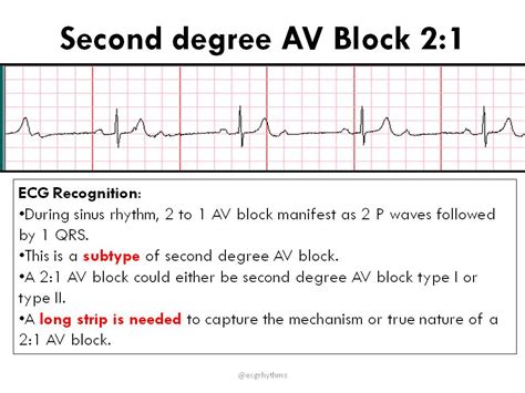 Sinus Rhythm With 2nd Degree Av Block