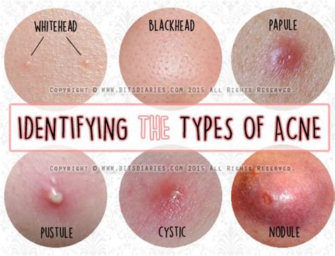 ALL ABOUT ACNE