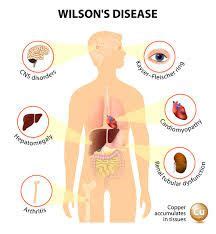 24 Best WILSON'S DISEASE ideas | wilson's disease, disease, wilson