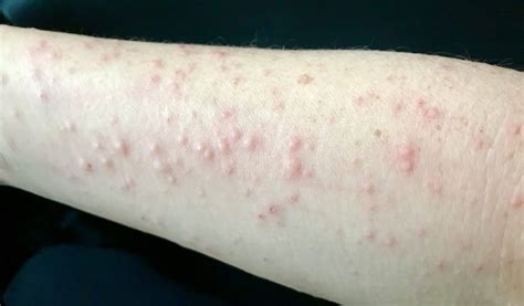 Scabies Rash On Arms