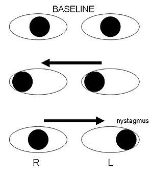 Internuclear ophthalmoplegia - Wikipedia