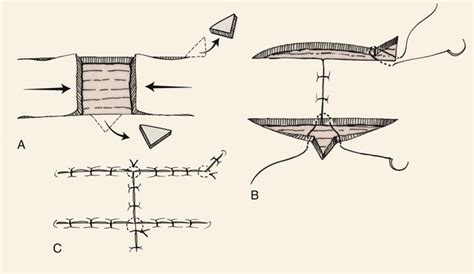 Advancement Flaps | Plastic Surgery Key