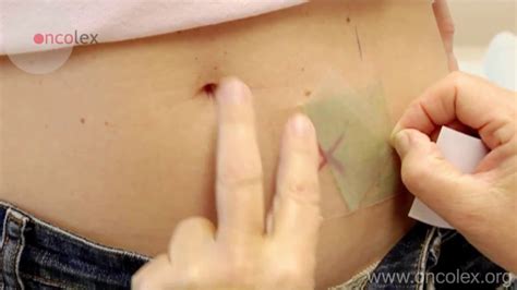 Stoma marking • Oncolex - YouTube