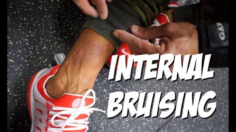 Internal Bruising - YouTube