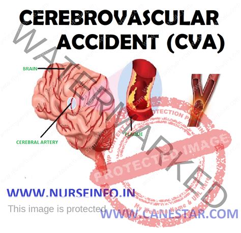 CEREBROVASCULAR ACCIDENT (STROKE) - Nurse Info