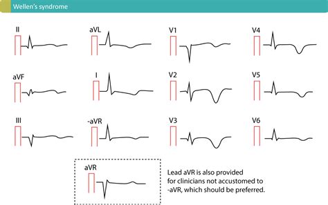 T-waves in ischemia: hyperacute, inverted (negative), Wellen's sign ...