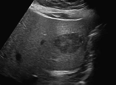 Abdomen and retroperitoneum | 1.1 Liver : Case 1.1.1 Focal nodular hyperplasia and hepatic ...