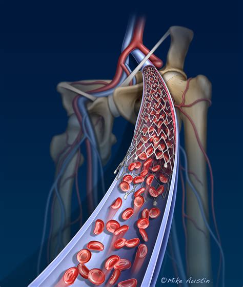 femoral Archives - Mike Austin | Internal Art Medical Illustration