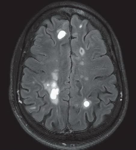 Acute Multiple Sclerosis Flare | Radiology Key