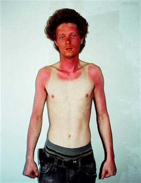 Funny Sunburn Pictures - Pictures Gallery Blog | Funny sunburn, Funny ...